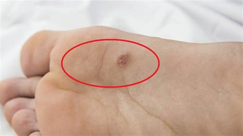 How To Remove Warts On Children's Feet Fast?