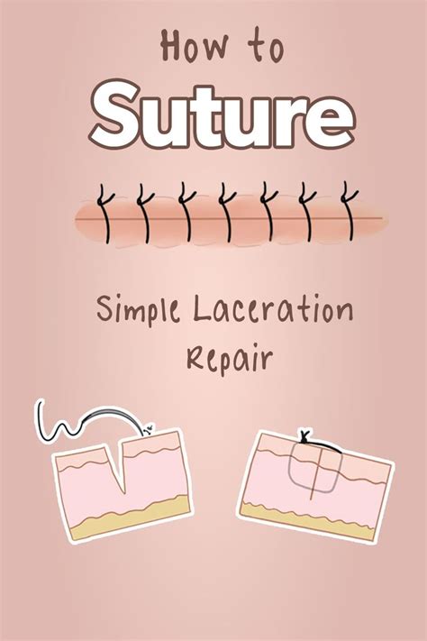 How To Suture Simple Laceration Repair Health And Willness