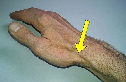 How To Treat And Prevent De Quervain S Tenosynovitis Precision Movement