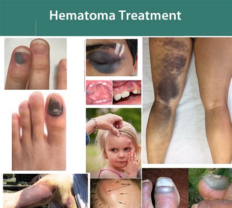 How To Treat Hematoma Under Skin? Fast Relief