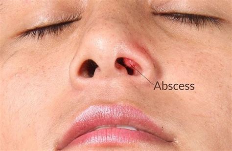 How To Treat Nose Abscess? Quick Relief Solutions