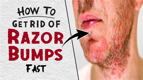 How To Treat Razor Bumps? Easy Home Remedies