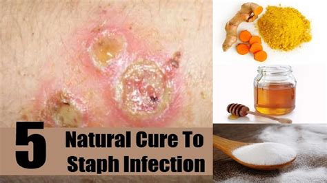 How To Treat Staph On Face? Home Remedies & Cures