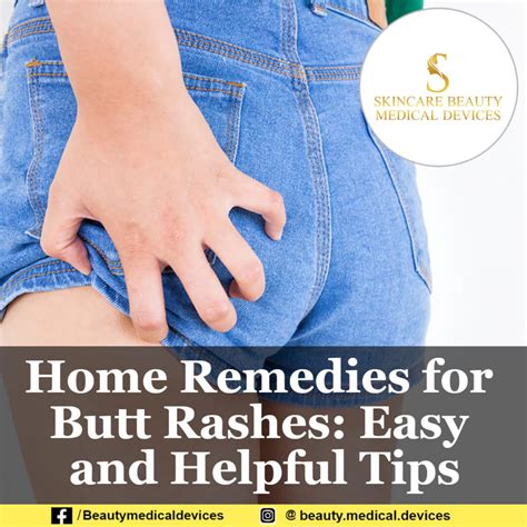 How To Treat Strep Buttocks Rash? Home Remedies