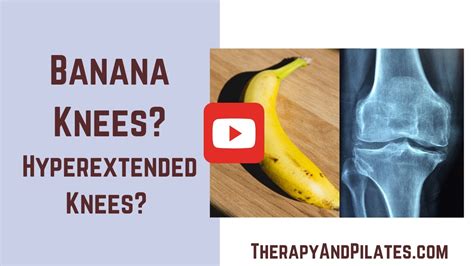 Hyperextended Knee Exercises How To Fix Banana Knees Knee