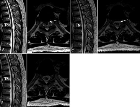 Icd 10 Cm Code For Thoracic Spine Spasm