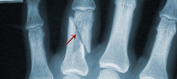 Impacted Fracture Archives Jeffrey Sterling Md