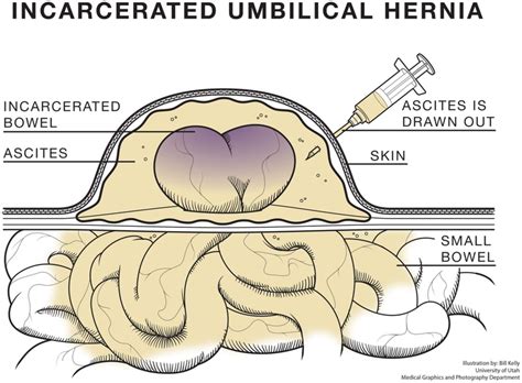 Incarceration Of Hernia