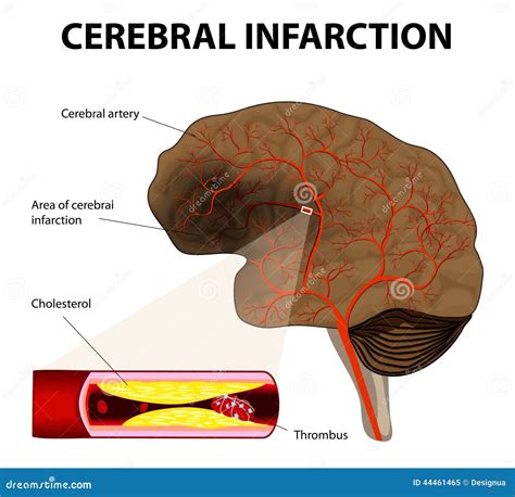 Infarto Cerebral