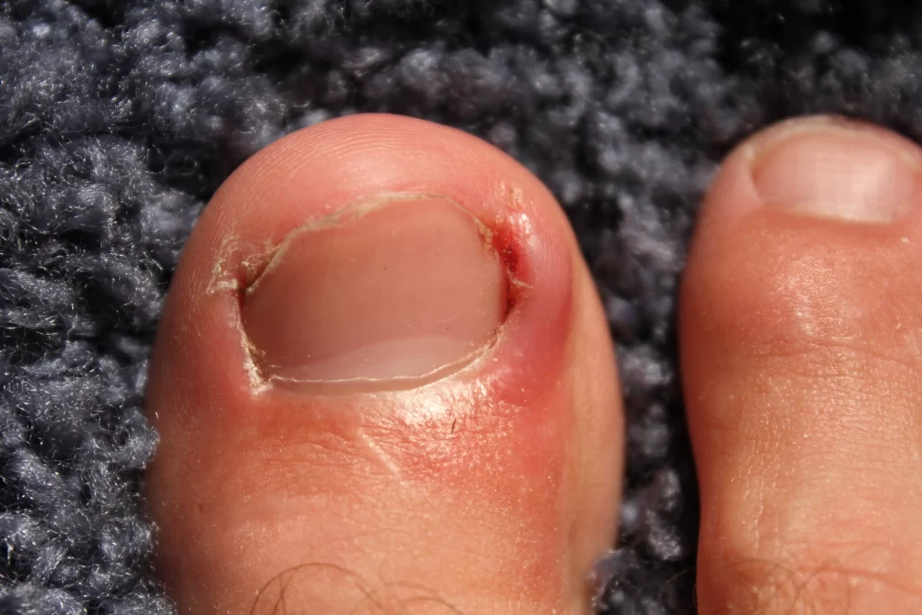 Ingrown Toenail The Footwork Clinic