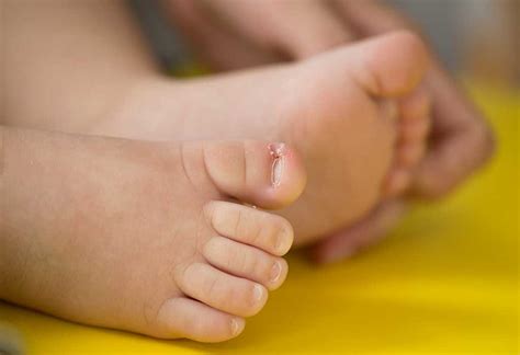 Ingrown Toenail Toddler