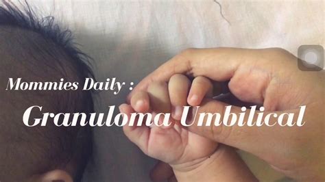 Ini Namanya Granuloma Umbilical Youtube