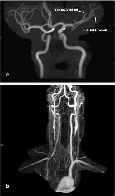 Initial Mr Study After Tpa Administration A Mra Of The Head Showing