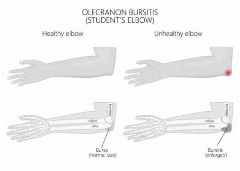 Injections For Olecranon Bursitis Steroid Injections For Elbow Pain