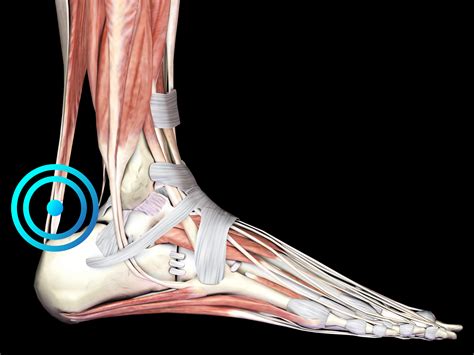 Insertional Achilles Tendinopathy Tendonitis Achilles