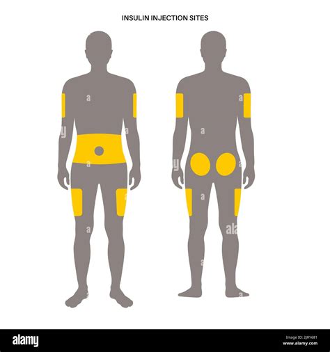 Insulin Injection Sites Illustration Stock Photo Alamy