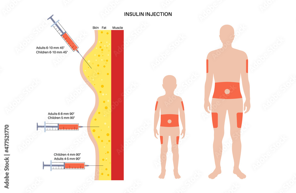 Insulin Injection Sites