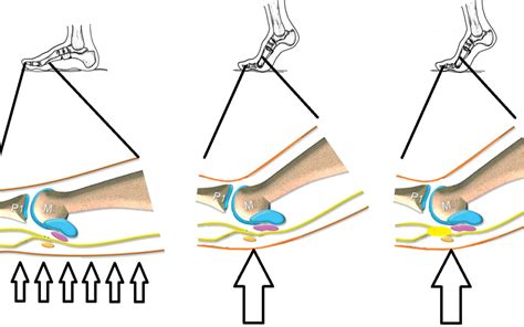 Intermetatarsal Bursitis Ankle Foot And Orthotic Centre