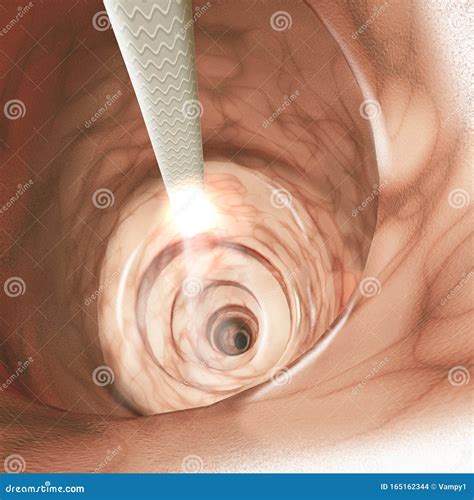 Internal View Of The Intestinal Walls Colonoscopy Is The Endoscopic