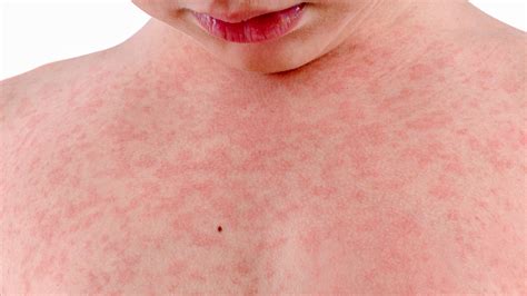 Itchy Skin Rash Following Viral Infection At Jeffrey Heasley Blog