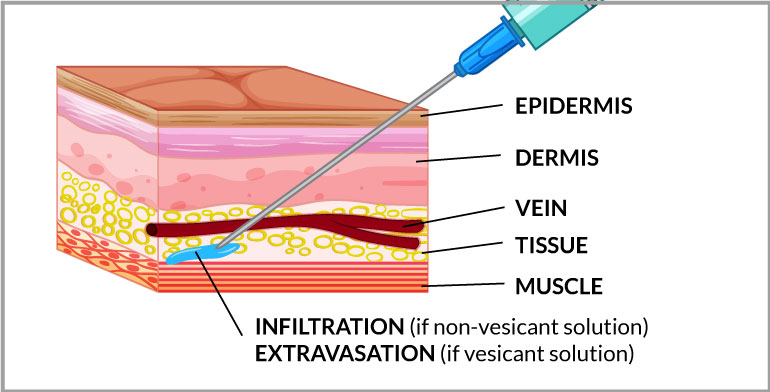 Iv Extravasation: Managing Complications Effectively