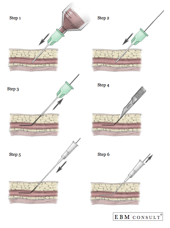 Iv Placement Chart