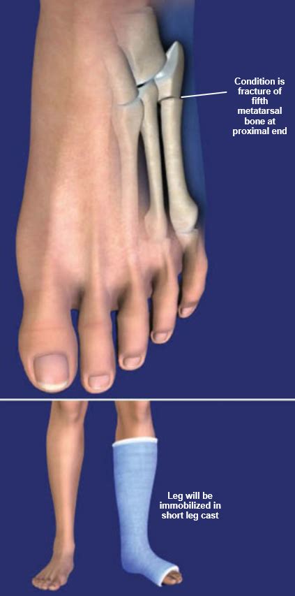 Jones Fracture Healing Guide