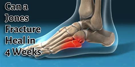 Jones Fracture Recovery Timeline