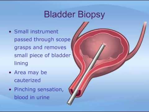 Kidney Stent Removal Cystoscopy My Transplant Lifestyle Youtube