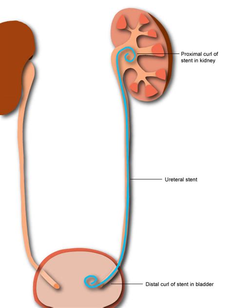 Kidney Stone Surgery Ureteral Stent With String Removal By The