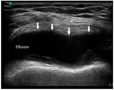 Knee Effusion Ultrasound