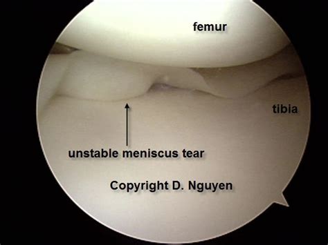 Knee Meniscus Teat Arthroscopy The Orthopedic Sports Medicine