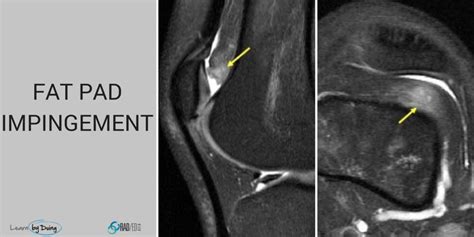 Knee Mri Fat Pad Impingement Where To Look What To Look For Radedasia