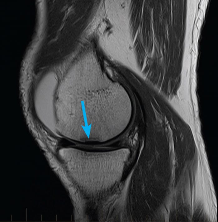 Knee Mri Guide: Diagnosis Explained