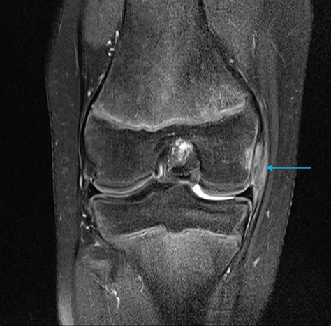 Knee Mri