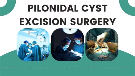 Know About Pilonidal Cyst Excision Surgery And Incision Surgery