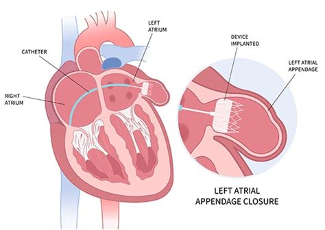 Laao Medical Abbreviation