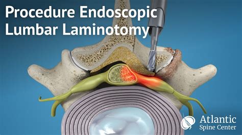 Laminectomy Laminotomy Procedures Depuy Synthes