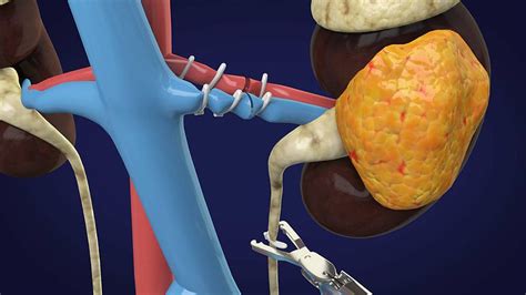 Laparoscopic Nephrectomy A1 Laparoscopic