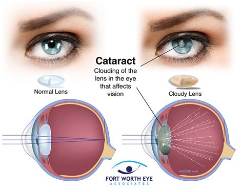 Laser After Cataract: Restores Clear Vision