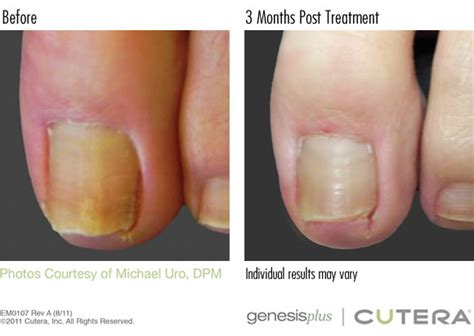 Laser Treatment For Toenail Fungus In Delray Beach Fl