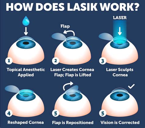 Lasik Healing Process