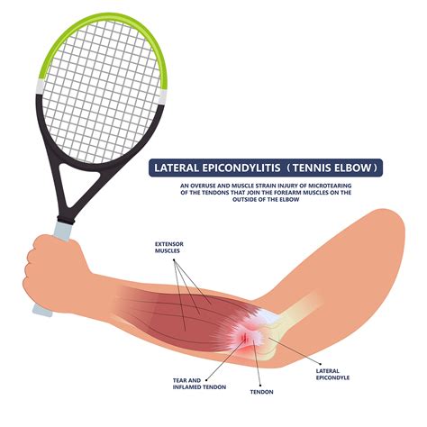 Lateral Epicondylitis Tennis Elbow Causes Symptoms Treatment How