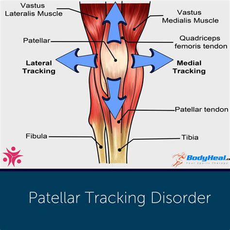 Lateral Patellar Tracking: Improve Knee Stability