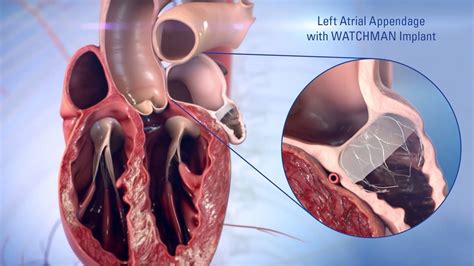 Left Atrial Occlusion: Improve Heart Health