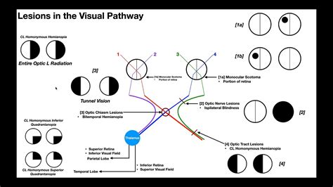 Lesions To The Visual Pathway Explained Youtube