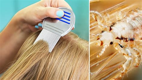 Lice In Our House Tips For Natural Lice Removal Treatment Youtube