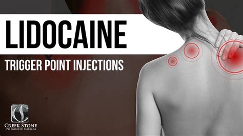 Lidocaine Trigger Point Injections