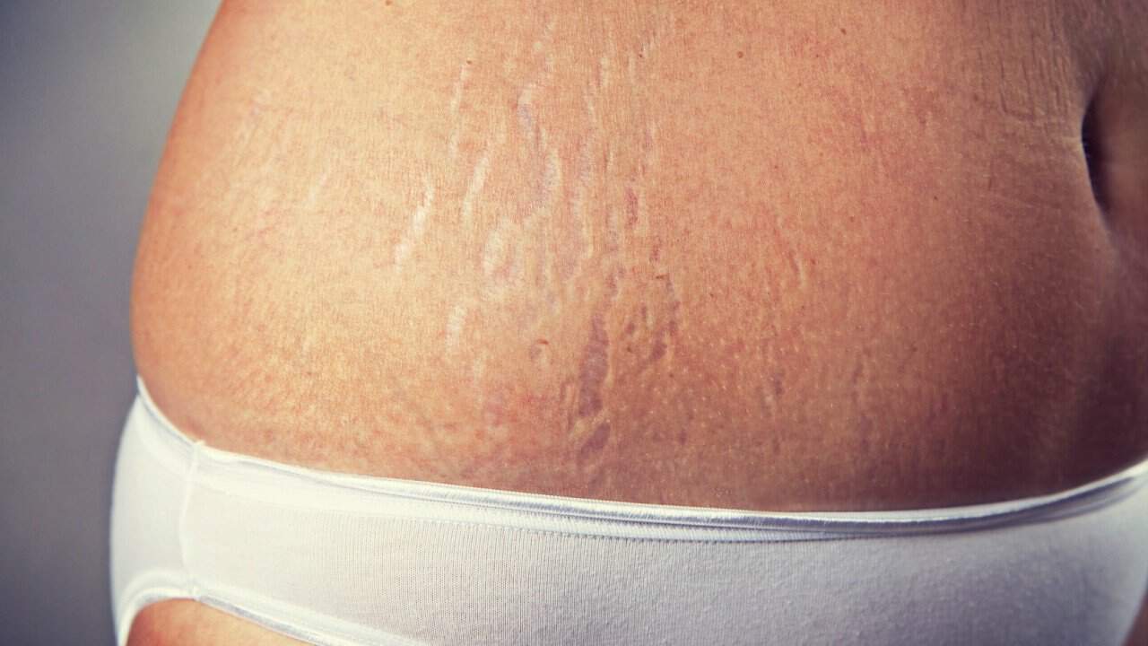 List 93 Pictures Stretch Marks After Pregnancy Pictures Sharp