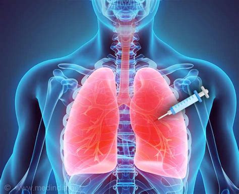 Lung Biopsy Indications Procedures Risks Faqs Reference